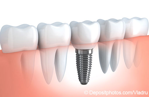 Günstige Implantate in München